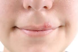 bệnh herpes miệng 