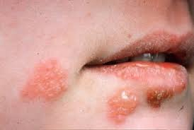 bệnh herpes miệng 2